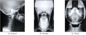 Orthospinology Upper Cervical Precision Xrays