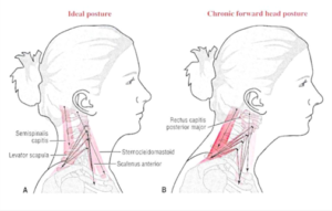 Head forward posture creates tension in the neck, shoulders, and head. 