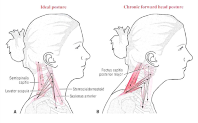 Can Posture Cause Headaches?