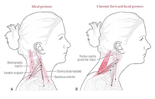 Can Posture Cause Headaches?