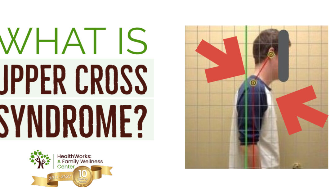 What Is Upper Cross Syndrome?