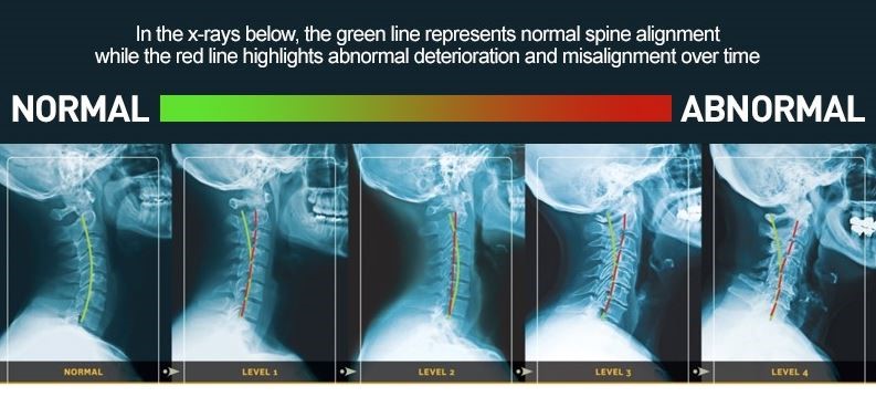 Should you go to a chiropractor if you have no pain?