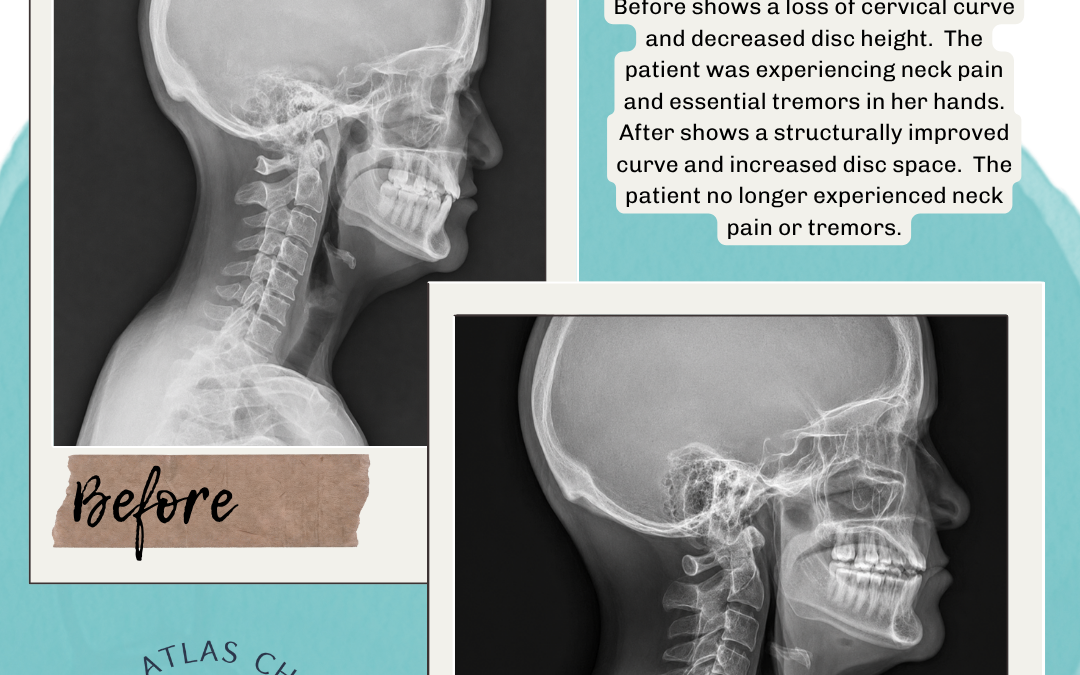 What Happens to the Discs in Your Neck Over Time with Upper Cervical Care?