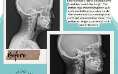 What Happens to the Discs in Your Neck Over Time with Upper Cervical Care?